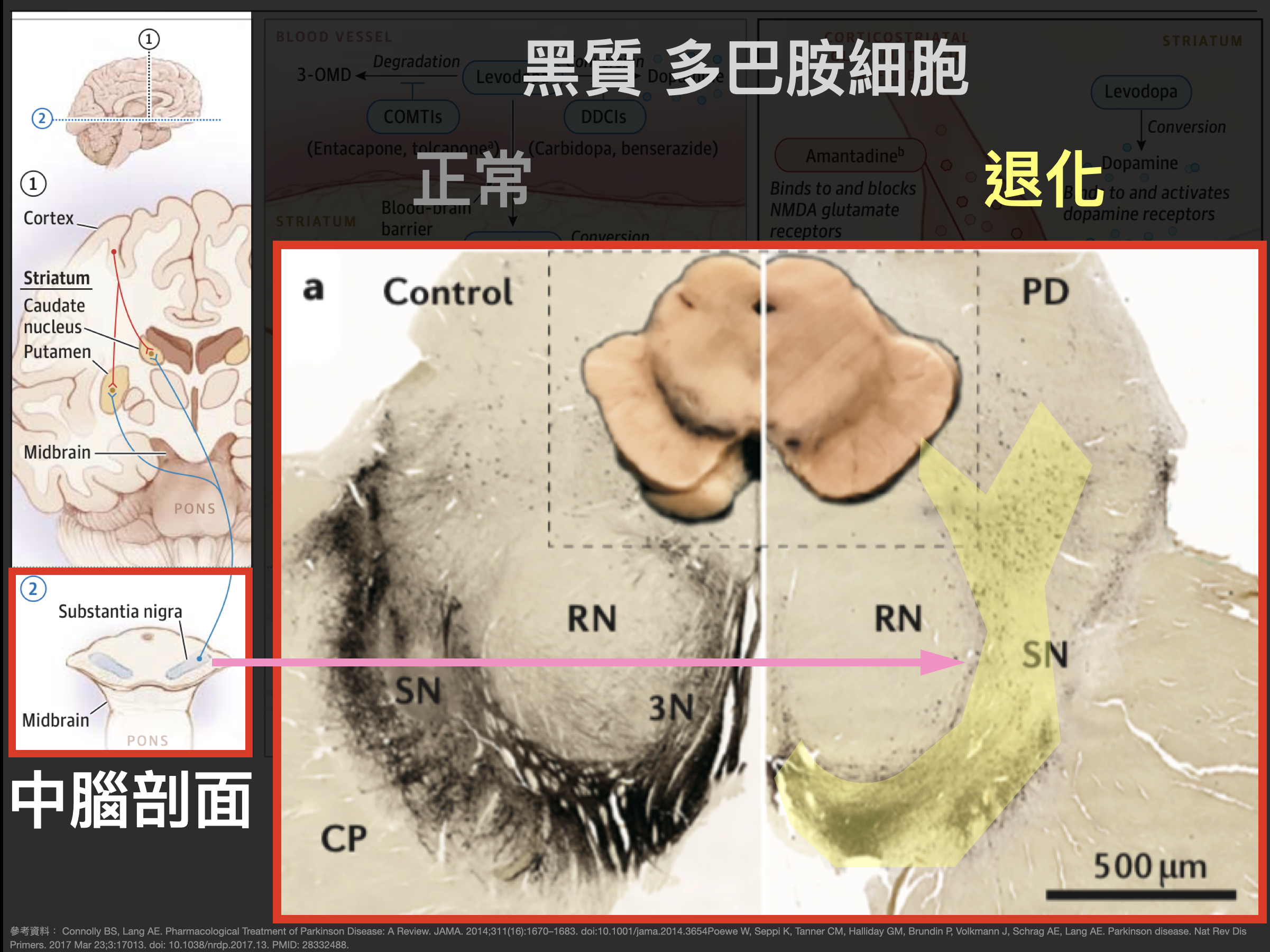 帕金森多巴胺退化